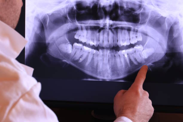 Best Broken or Cracked Tooth Emergency Dentist in Bloomington, CA